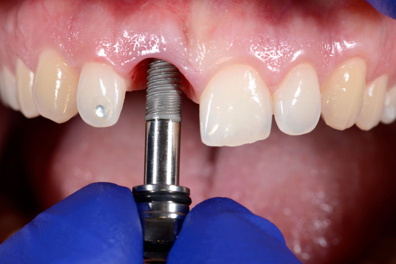 Quem Nao Pode Fazer Implante Dentario